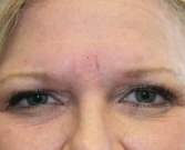 Feel Beautiful - Filler (hyaluronan) into squint lines - After Photo